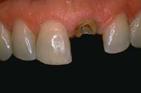 Clean, shape, and etch the canal and prepare for composite bonding.