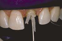 Using a dual-cure flowable composite, fill the canal 3/4 full. Place the fibers so that the end extend out of the canal to the height of the core.