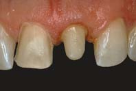 Build up the core around the protruding ends of Ribbond. Cure, and shape the core.