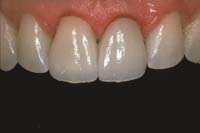 The finished fiber reinforced composite build-up is especially good for anterior teeth where a porcelain or empress crown will be used.
