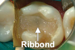 Ribbond placed in build-up