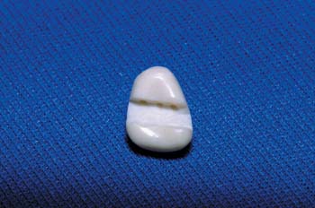 Natural tooth pontic