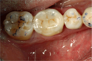 Build up occlusal surfaces